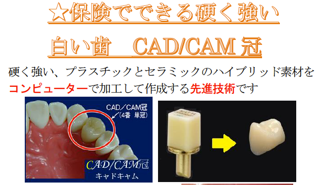 cad cam